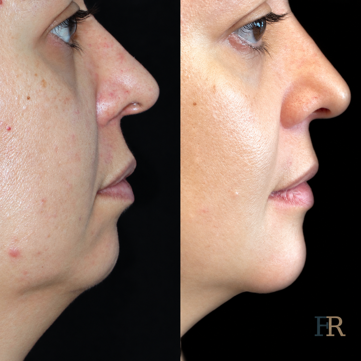 Prótese facial (mento)