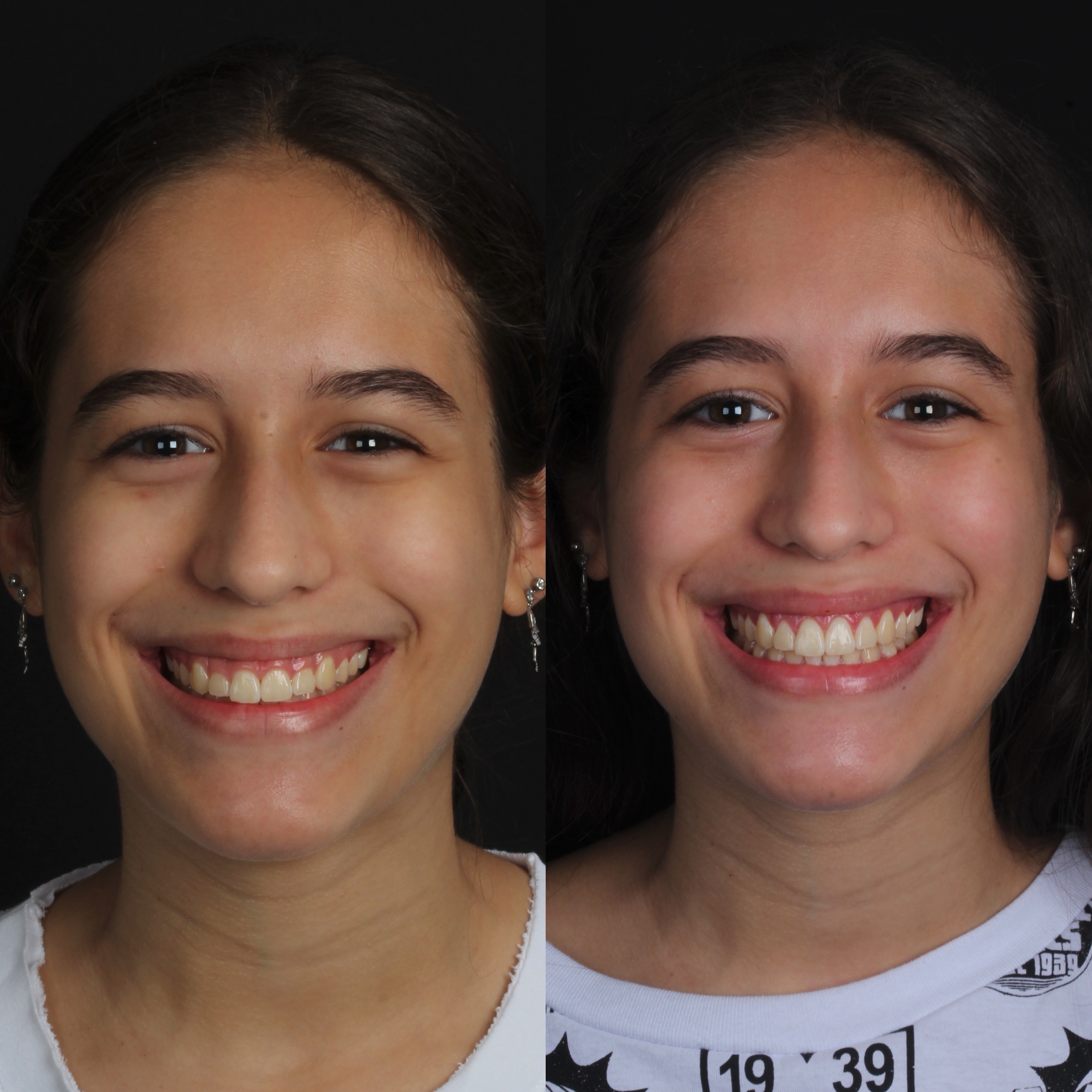 Gengivoplastia — comparação facial