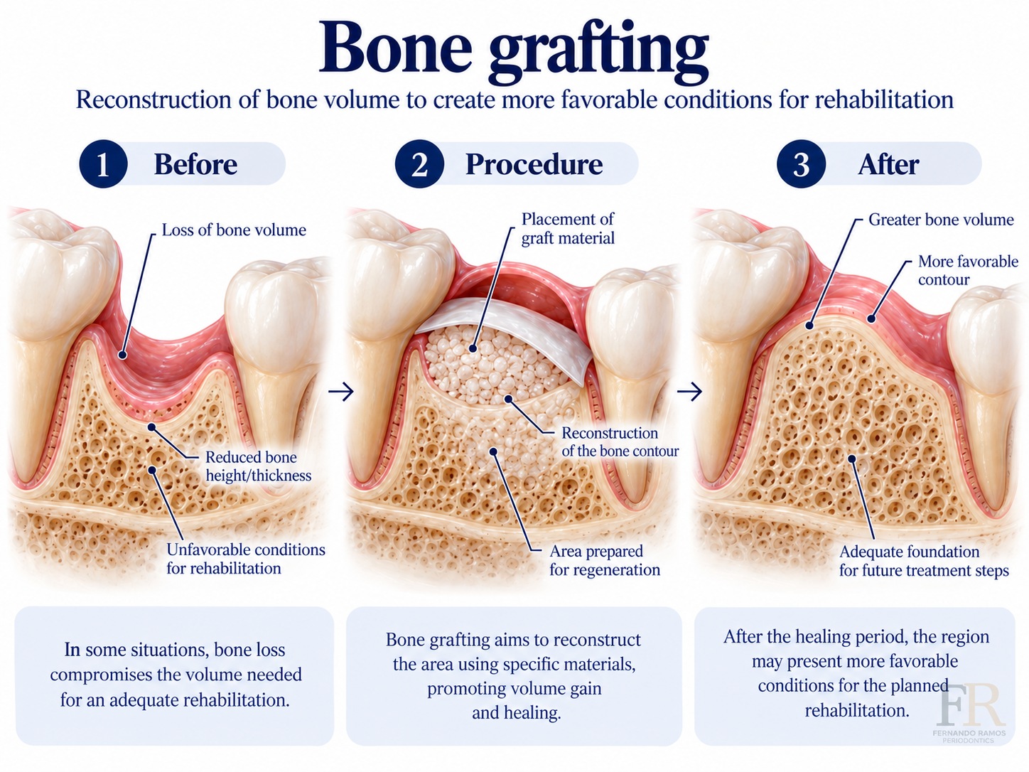 Bone grafting · Educational illustration