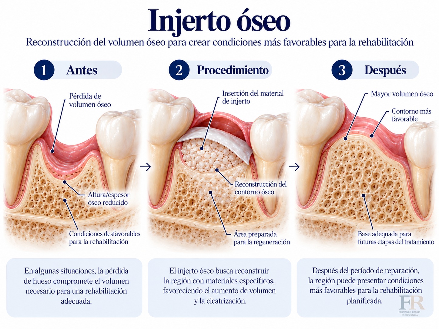 Injertos óseos · Ilustración educativa