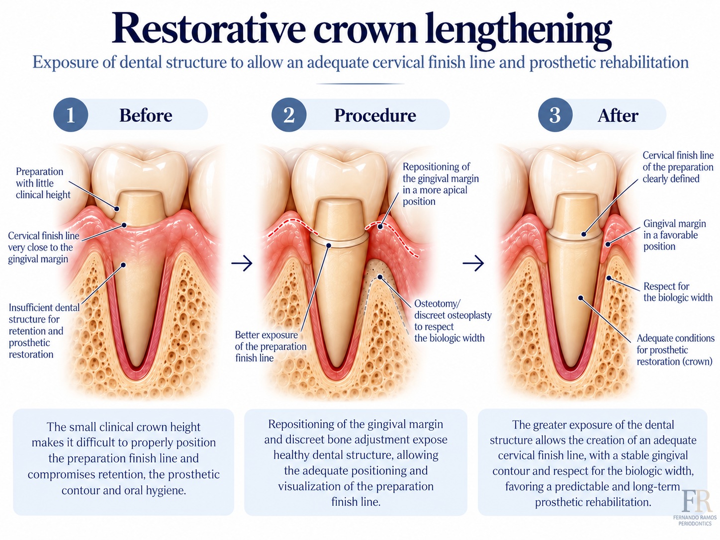 Restorative crown lengthening · Educational illustration