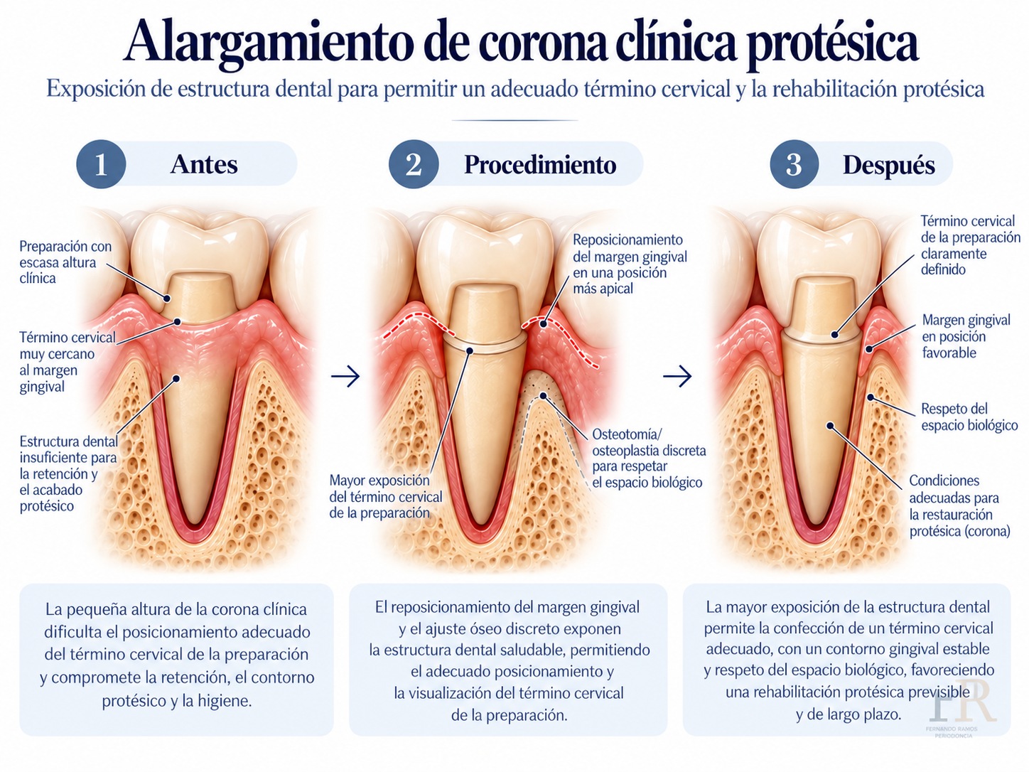 Alargamiento de corona clínica para restauración · Registro clínico