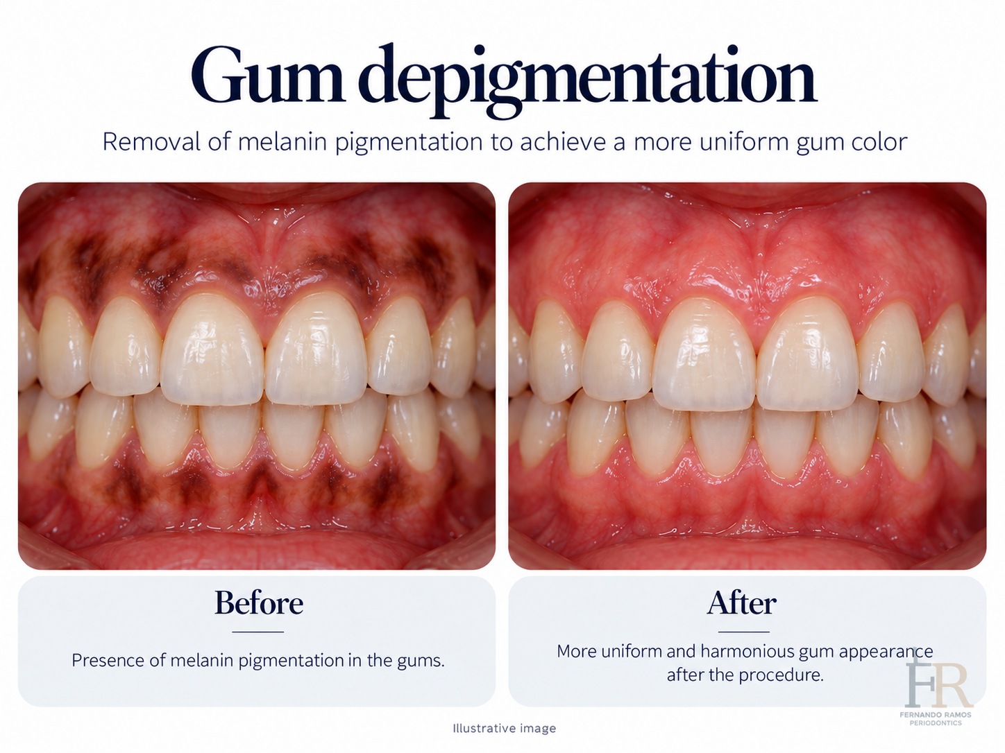 Gum depigmentation · Educational illustration