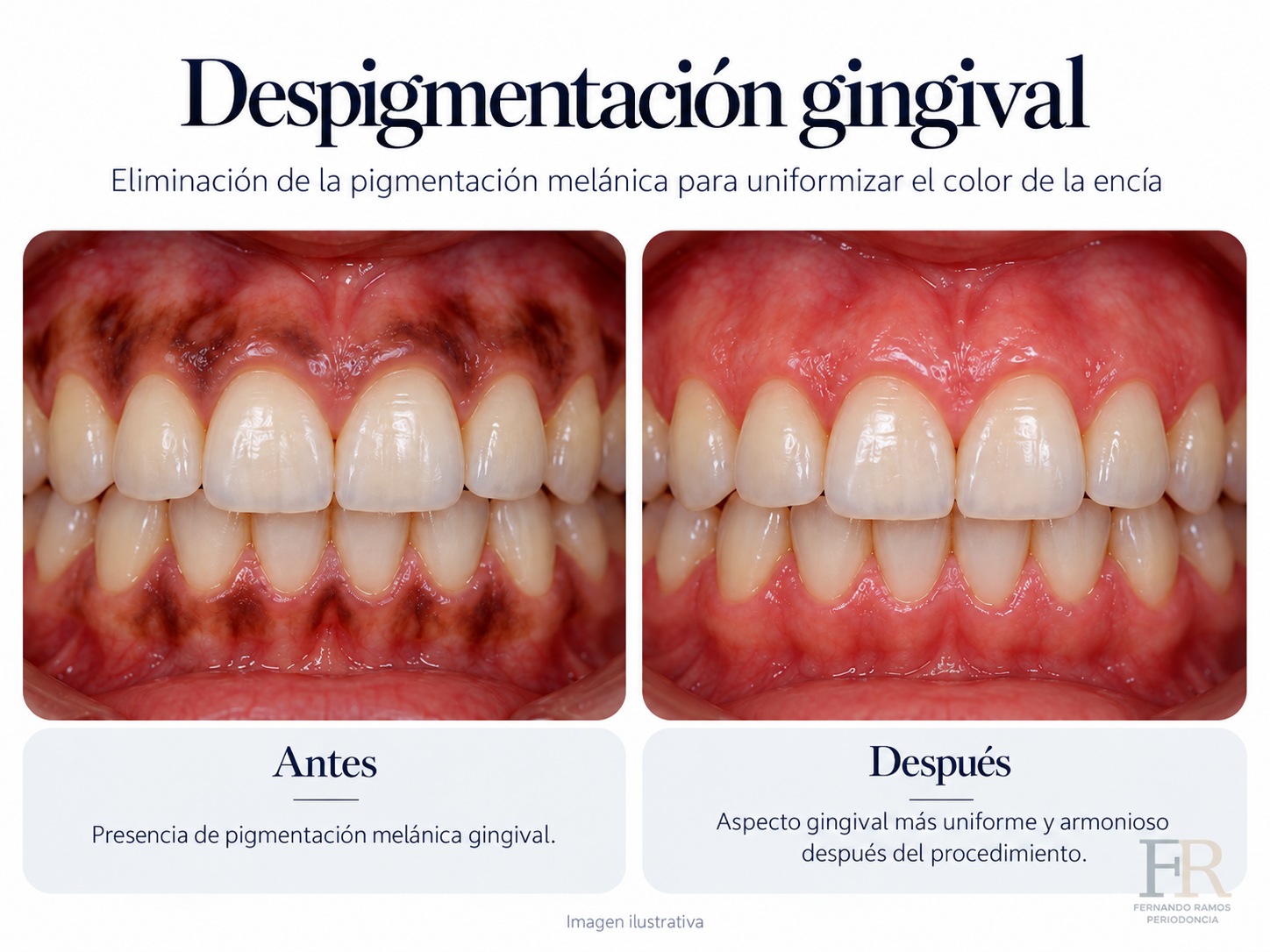 Despigmentación gingival · Ilustración educativa