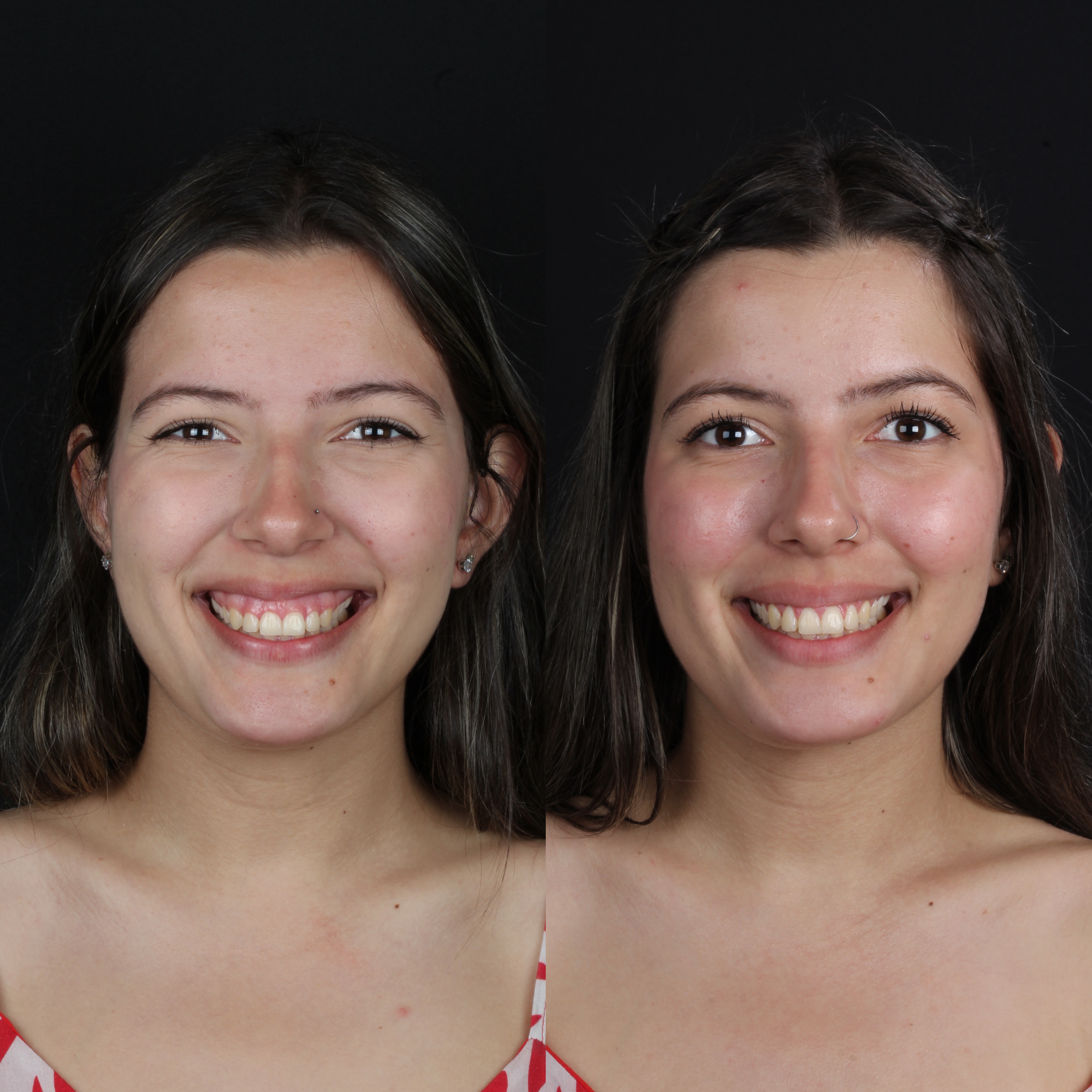 Gengivoplastia — comparação facial