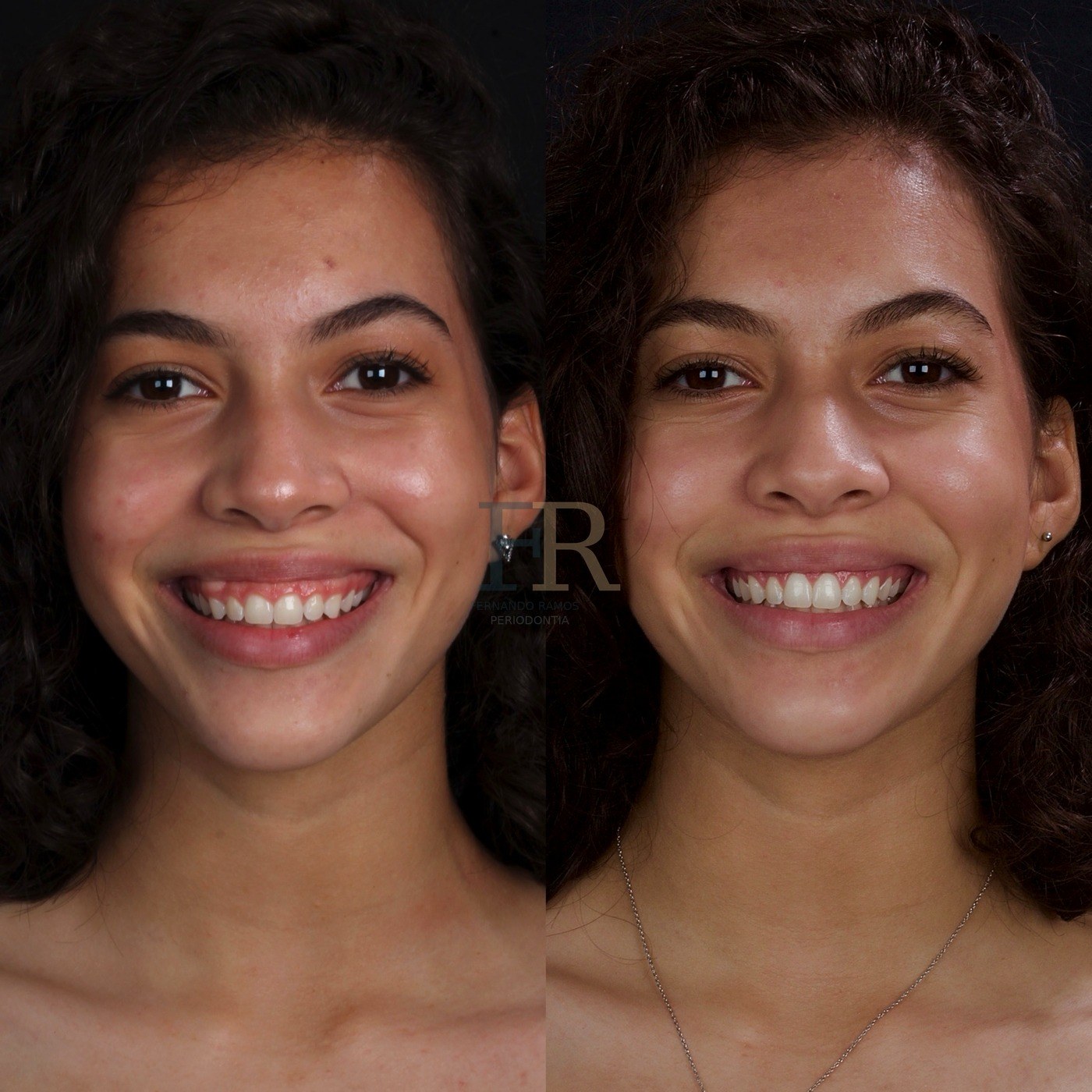 Sorriso gengival facial
