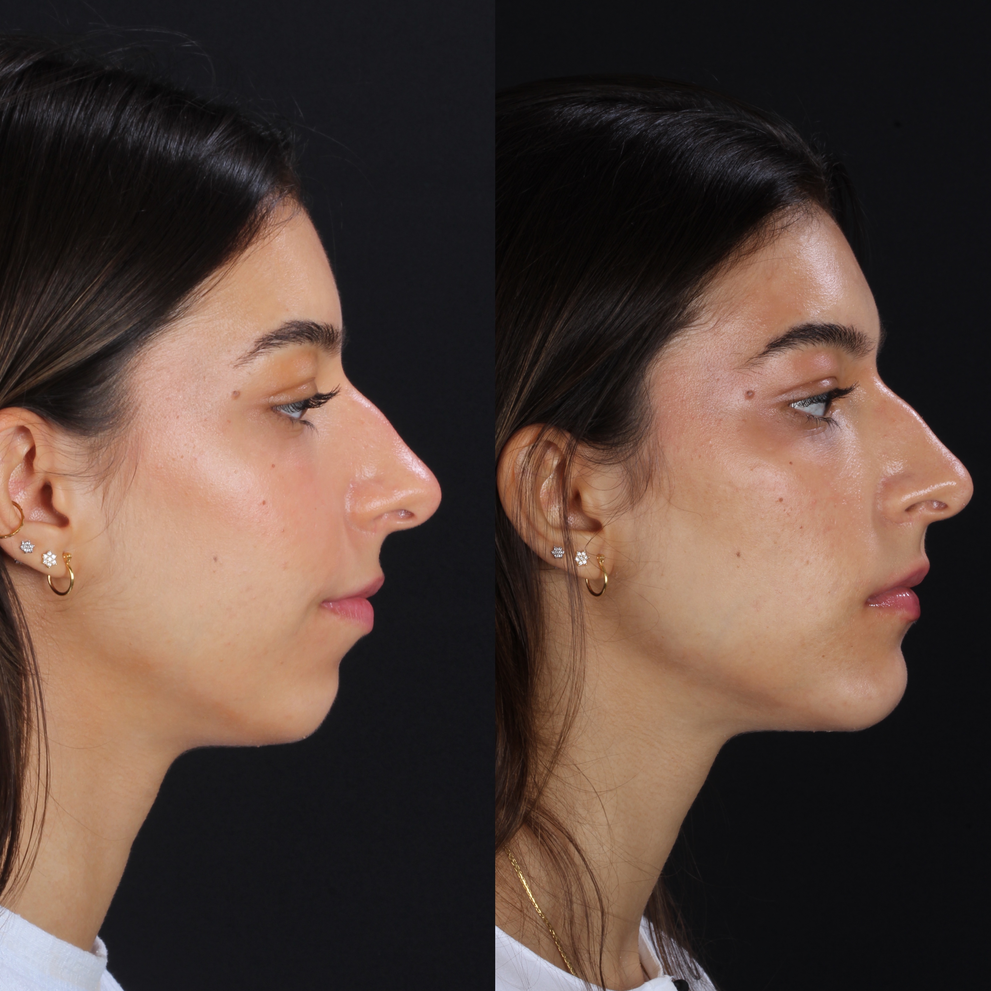 Próteses faciais: comparação dos perfis antes e depois